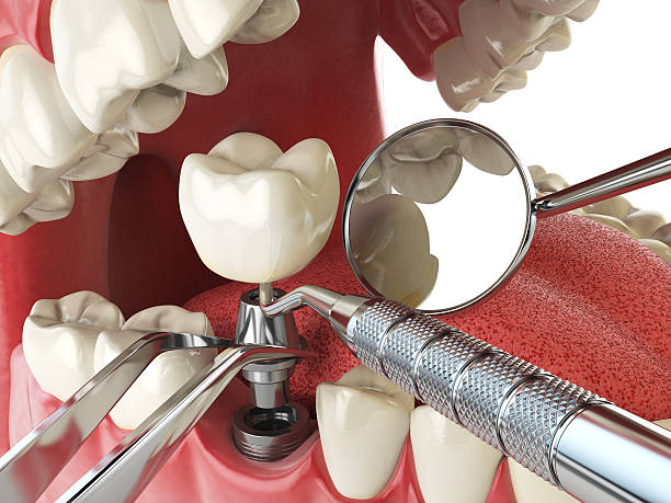 Best Broken or Chipped Tooth Repair in Tye, TX